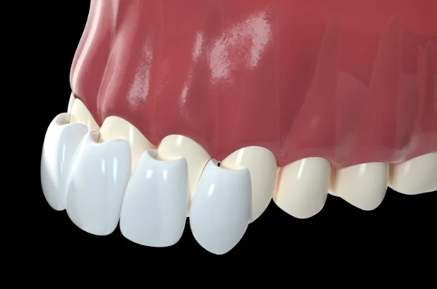 Faseta Dentare