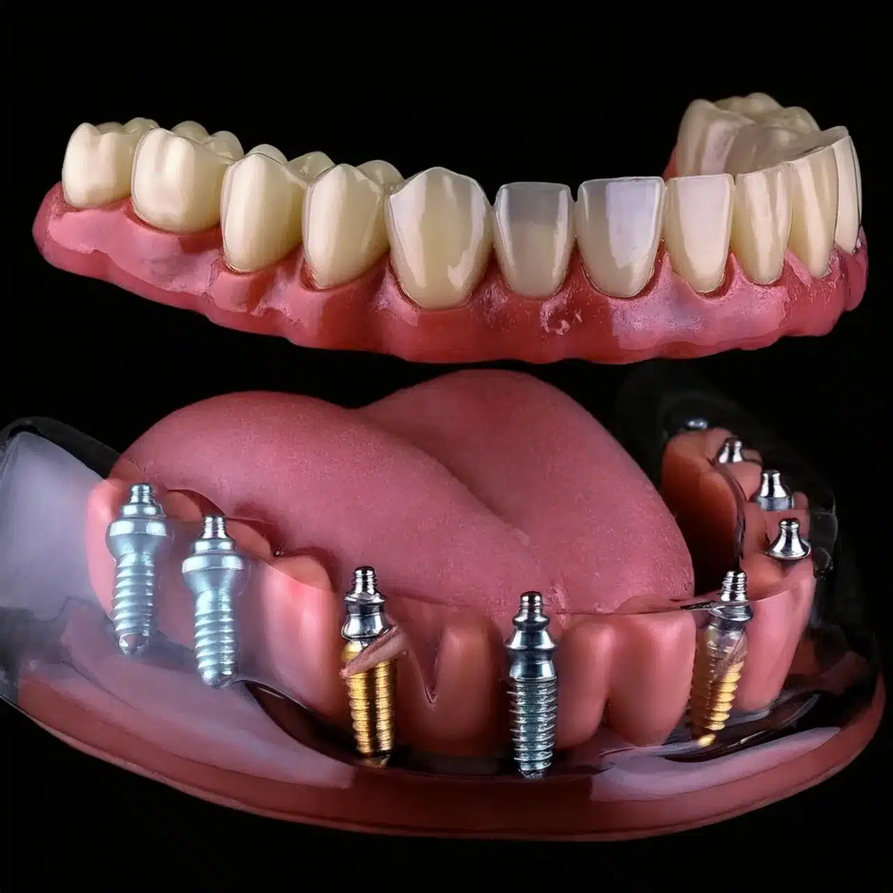 Implante Dentare